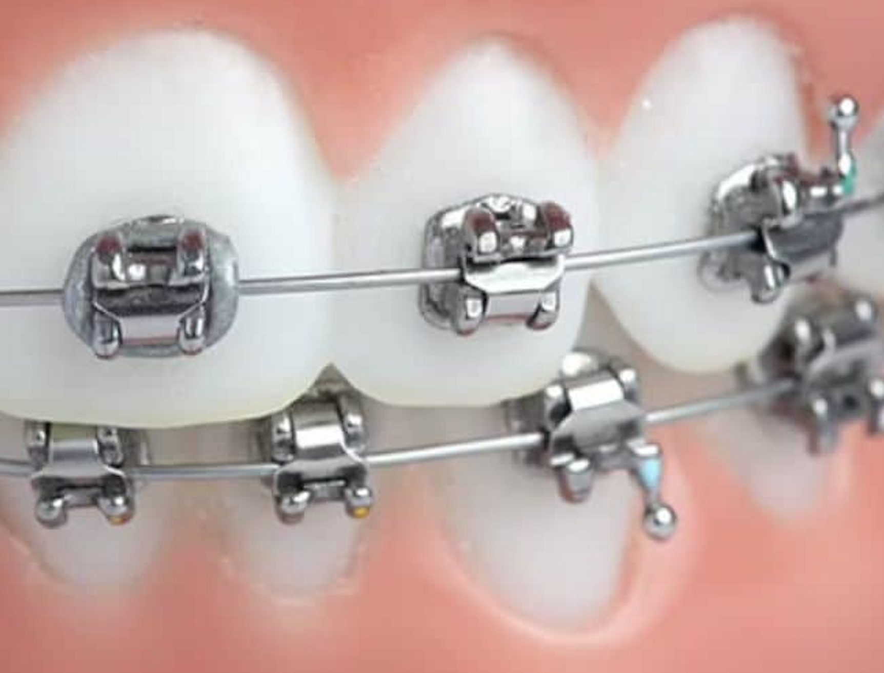 bagues metal Faux palais - Appareil amovible