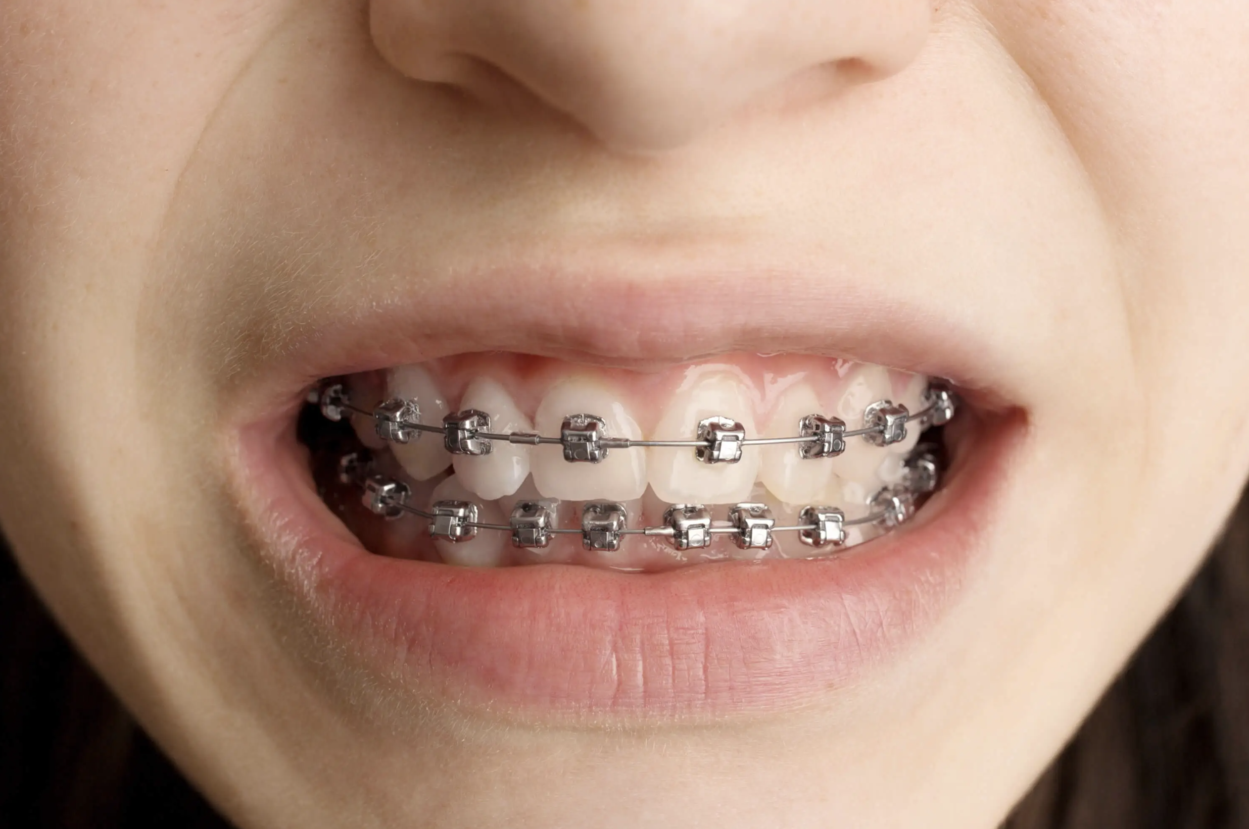 braces Faux palais - Appareil amovible