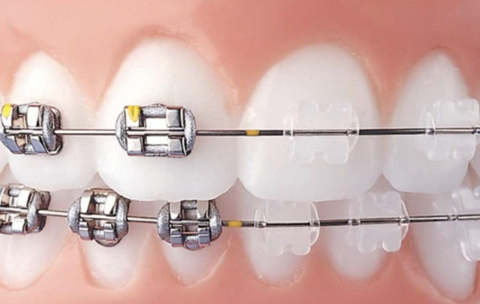 ceramique Faux palais - Appareil amovible